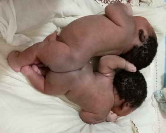 image showing conjoined twins
